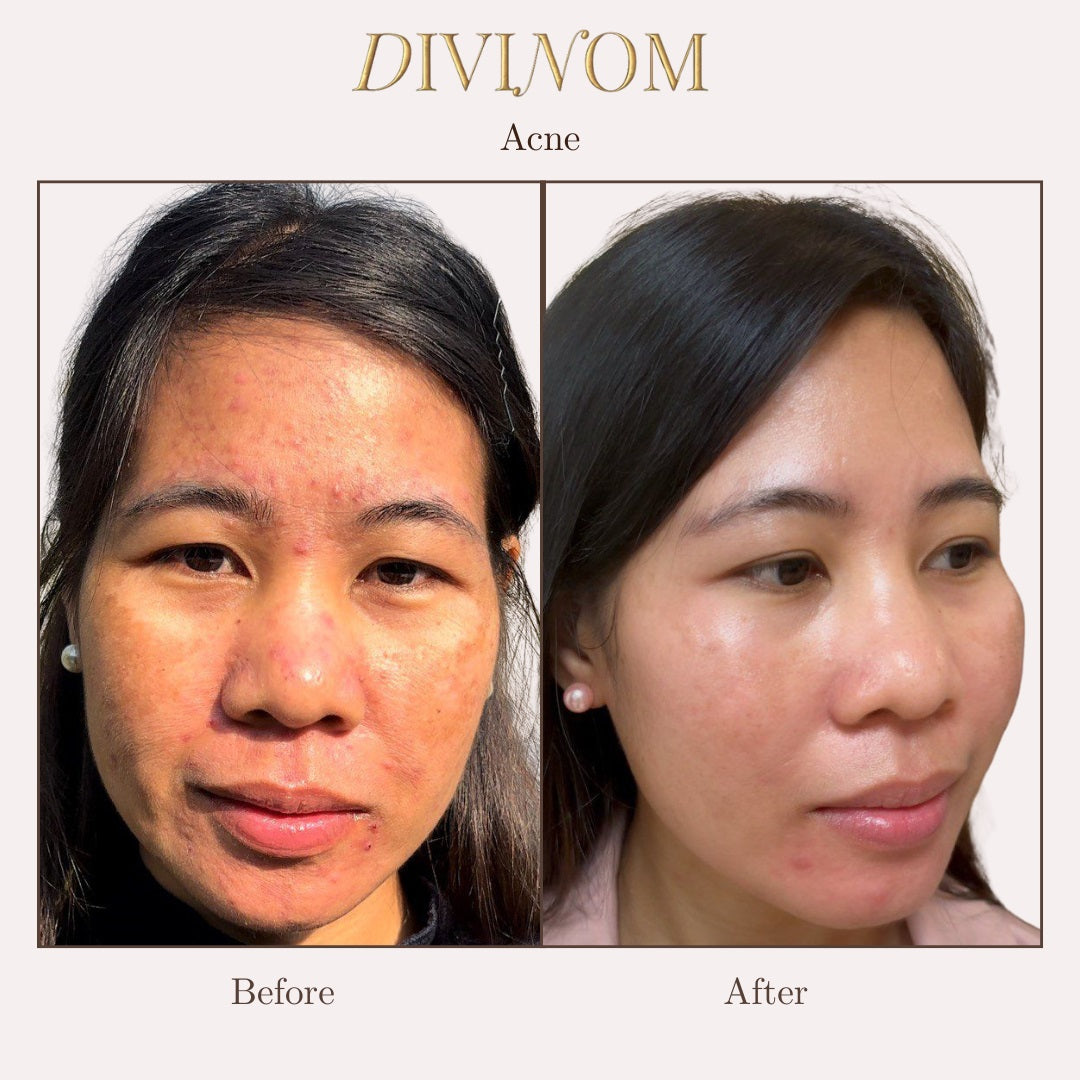 Acne Skin Detox Set